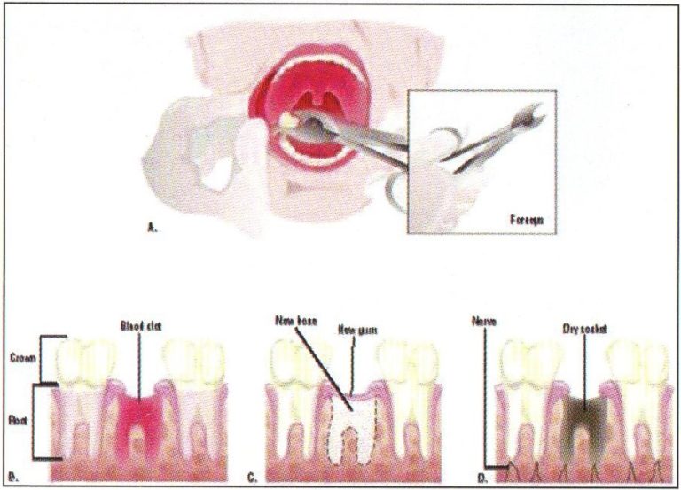 Dry Socket - Deep Dental Clinic And OPG Centre