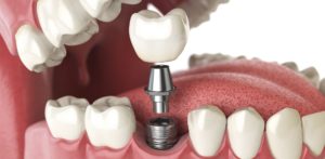 Dental implant