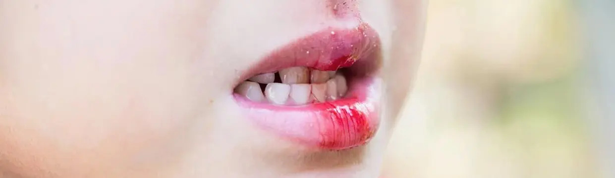 Dental Emergencies