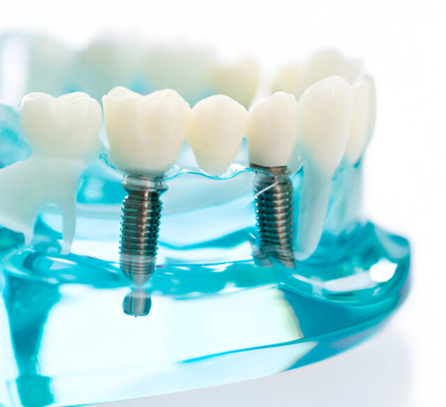 Alpha Bio Dental Implants in Mohali