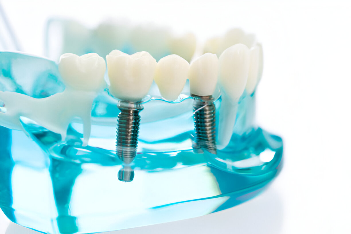 Alpha Bio Dental Implants in Mohali