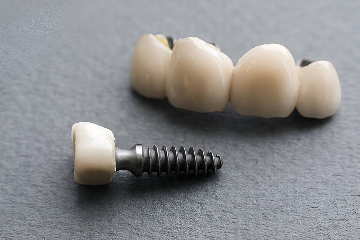 Straumann Dental Implants