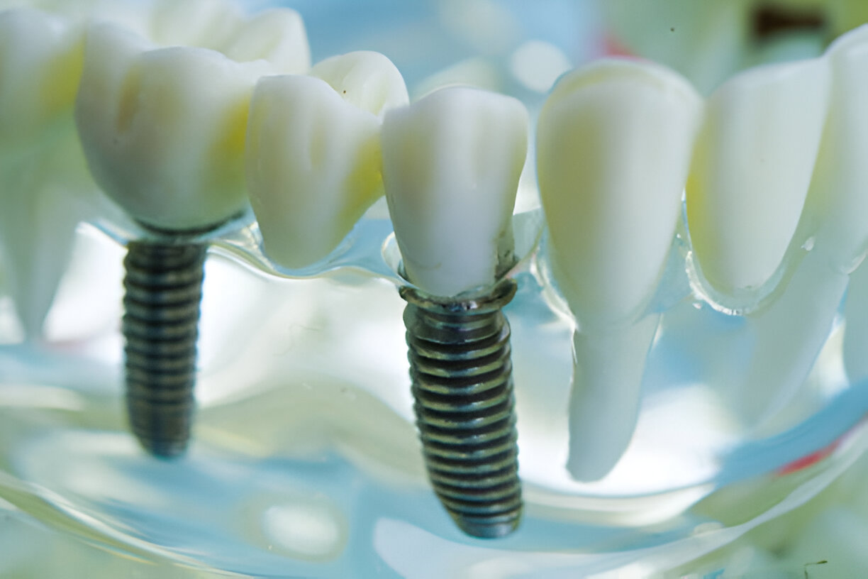 Straumann Dental Implants