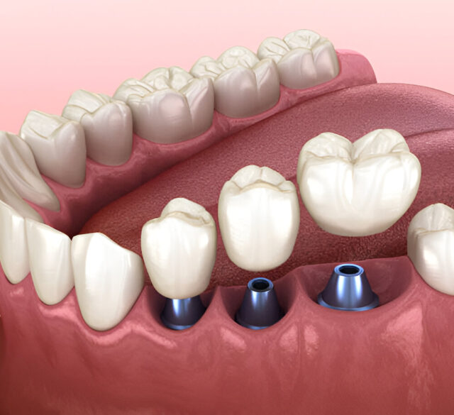 Zimmer Dental Implants in Mohali