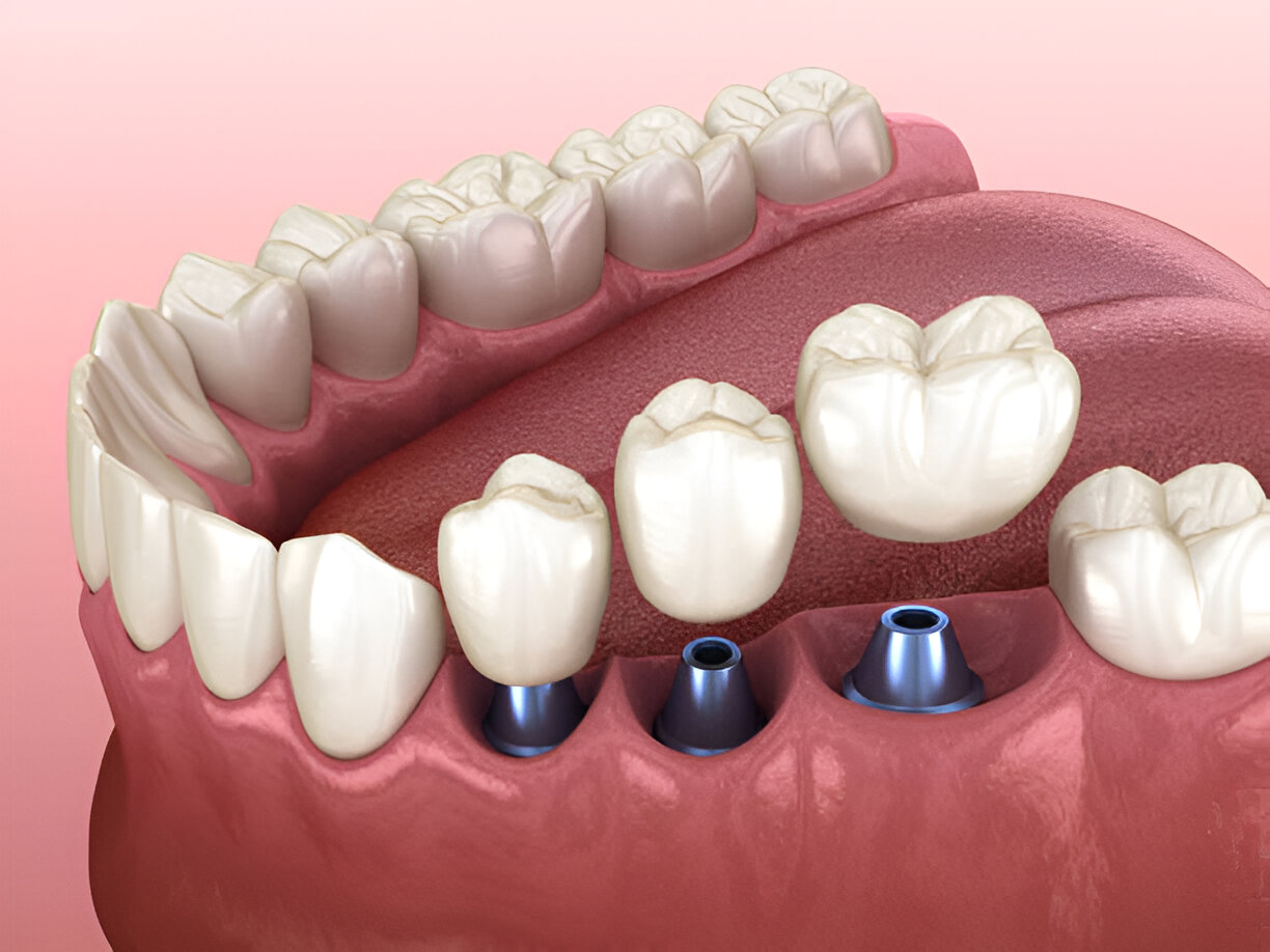 Zimmer Dental Implants in Mohali