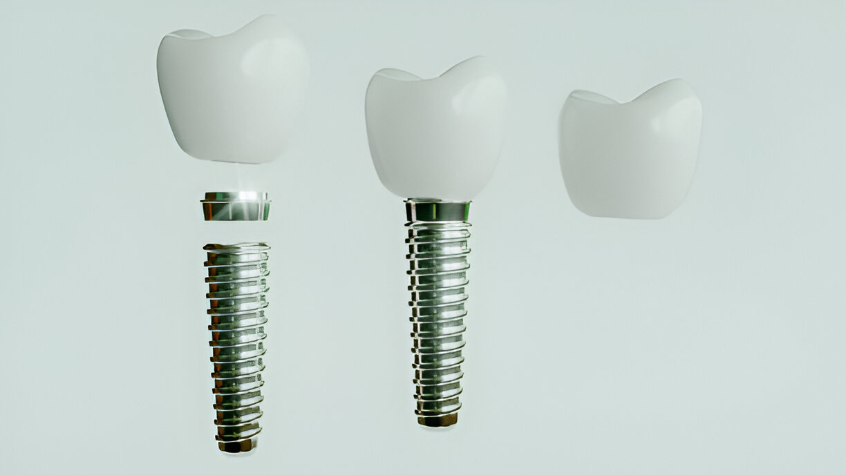 Alpha Bio Dental Implants in Mohali