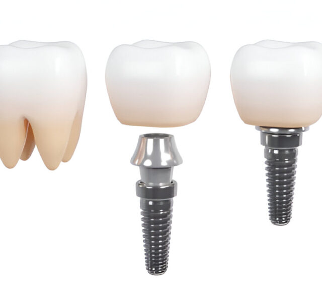 Straumann Dental Implants