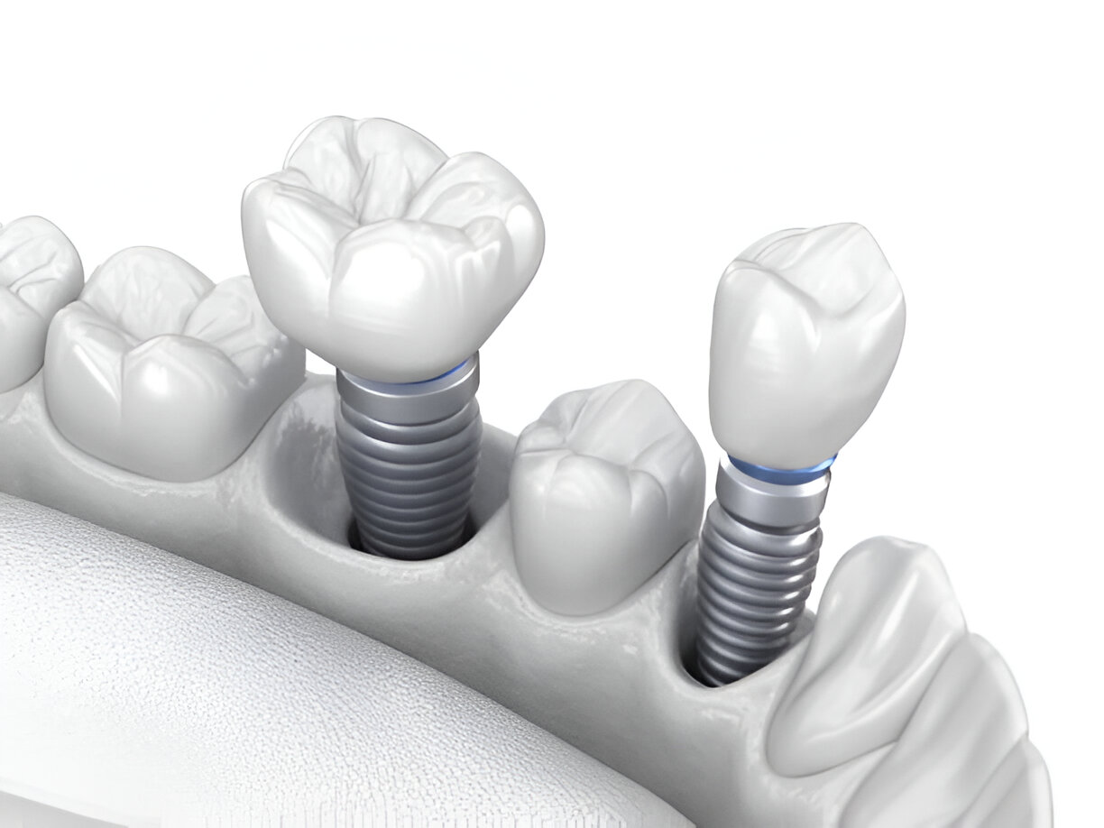 Zimmer Dental Implants in Mohali