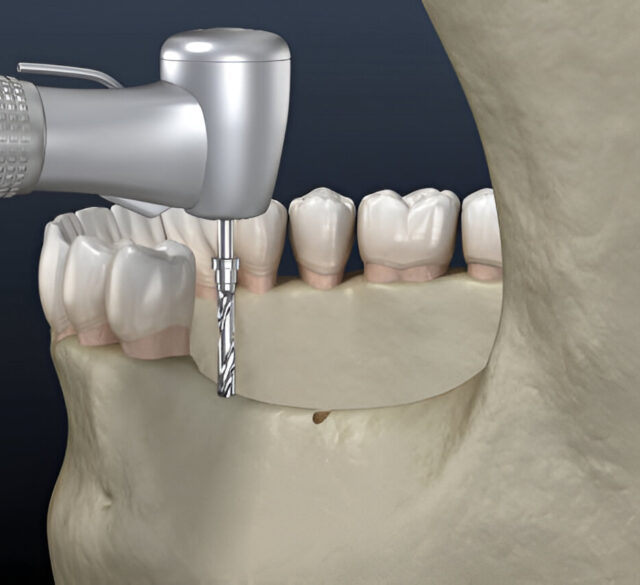 Osstem Dental Implants in Mohali