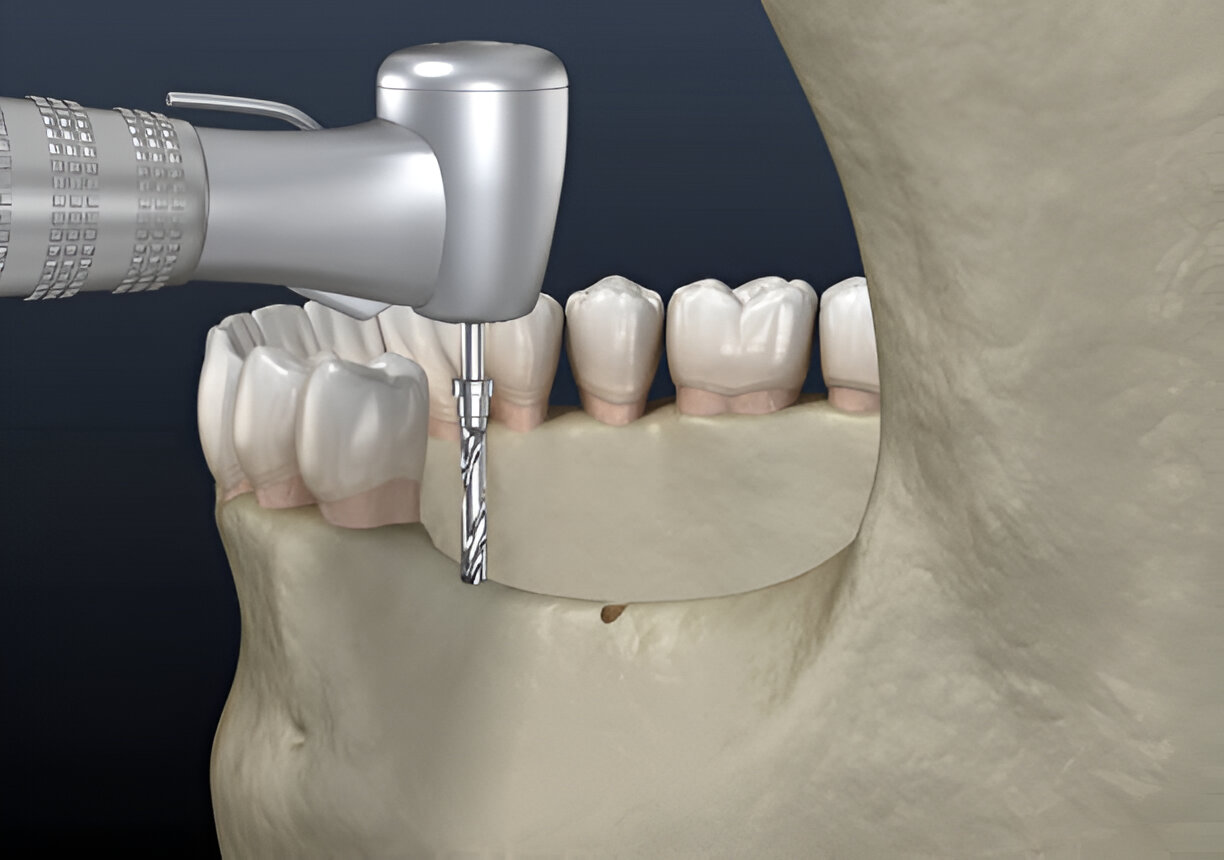 Osstem Dental Implants in Mohali