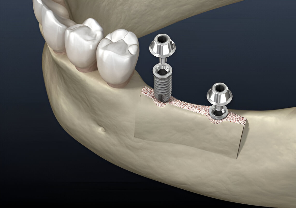 Osstem Dental Implants in Mohali