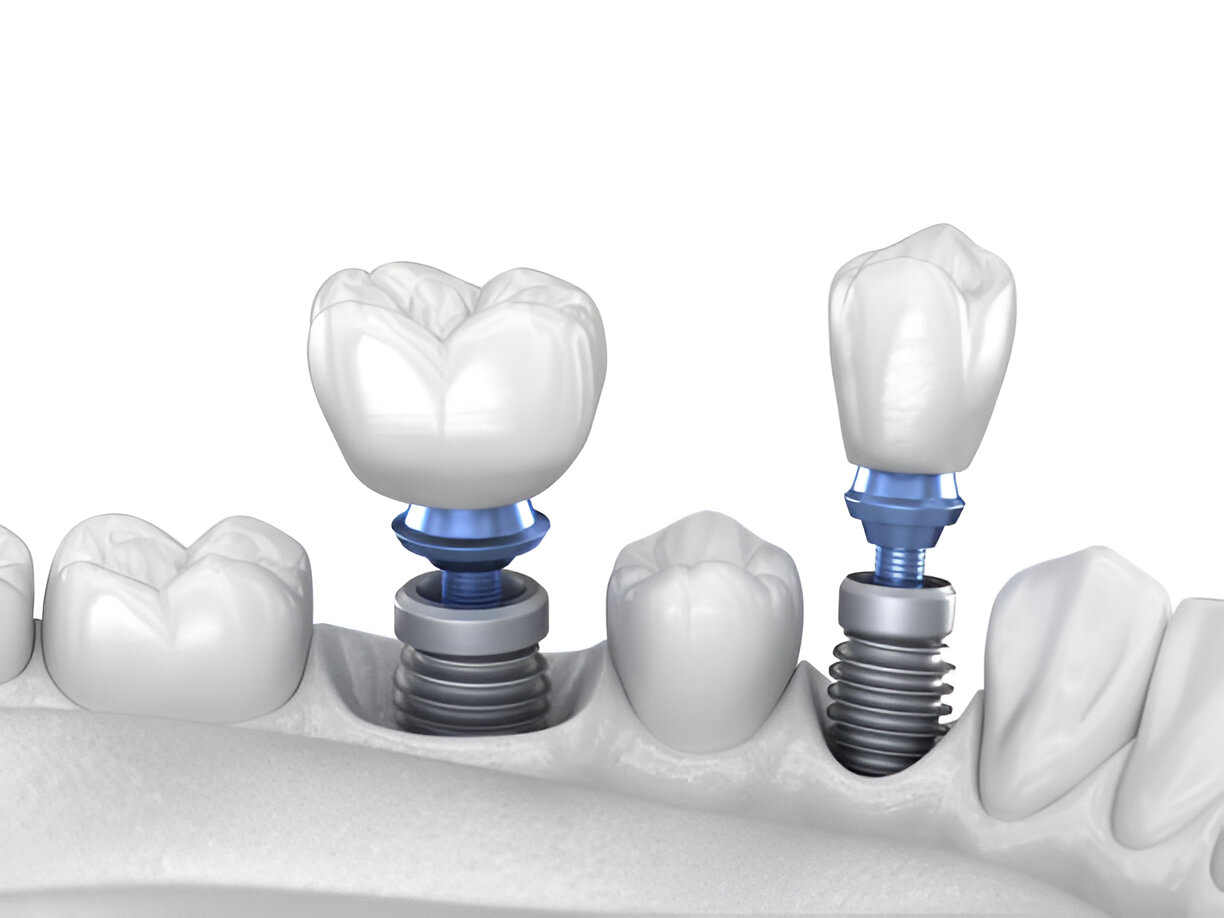 Osstem Dental Implants in Mohali